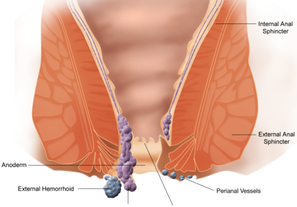 hemorrhoids