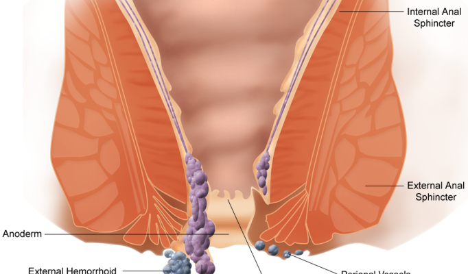 hemorrhoids