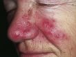 rosacea