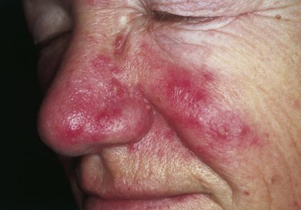 rosacea