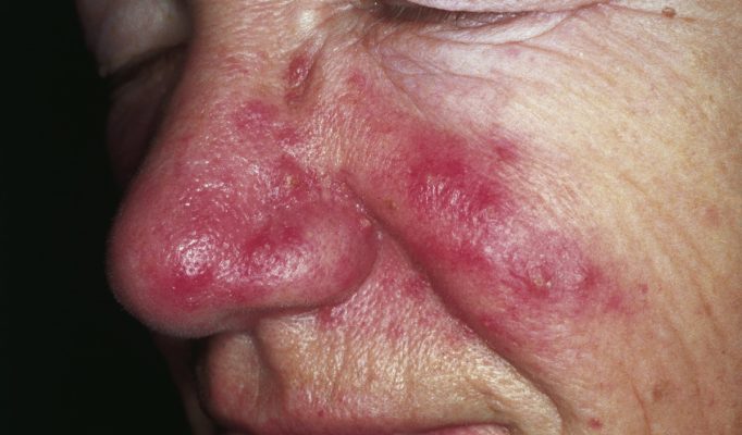 rosacea